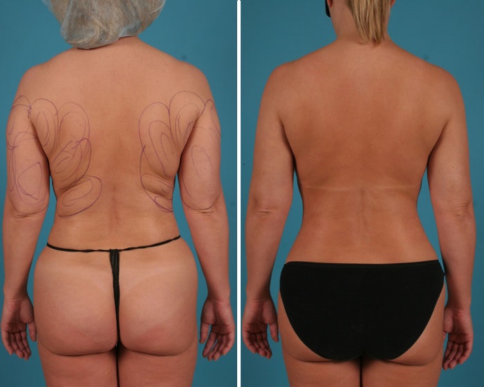 Liposuction in Delhi at Affordable Cost